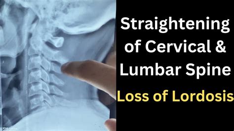 Straightening Of Cervical Curvature Loss Of Lumbar Lordosis Lumbar Curvature Straightening In