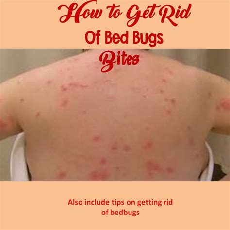 What Are Bed Bugs Bed Bug Bites Treatment Diy Bed Bug Vrogue Co