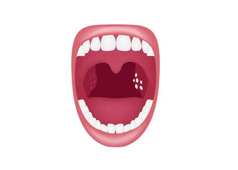 Our Calgary Dentist Explains Tonsil Stones Advance Your Health