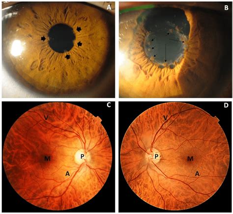 Biomicroscopic Photographs Slit Lamp Of The Anterior And Posterior