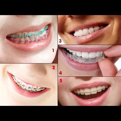 Jual Kawat Gigi Oleh Klinik Gigi Senyum Ceria