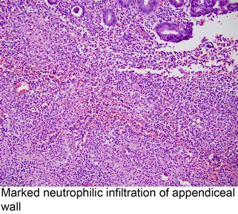 Pathology Outlines Acute Appendicitis