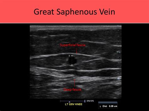 Greater And Lesser Saphenous Veins