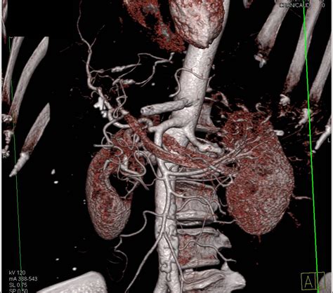 Stent In Celiac Artery Is Occluded Vascular Case Studies Ctisus Ct