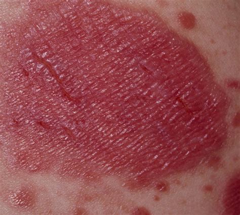 Plaque Psoriasis Current Health Advice Health Blog Articles And Tips