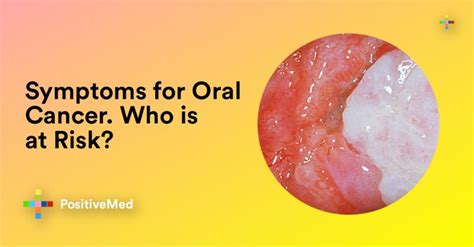 Symptoms For Oral Cancer Who Is At Risk