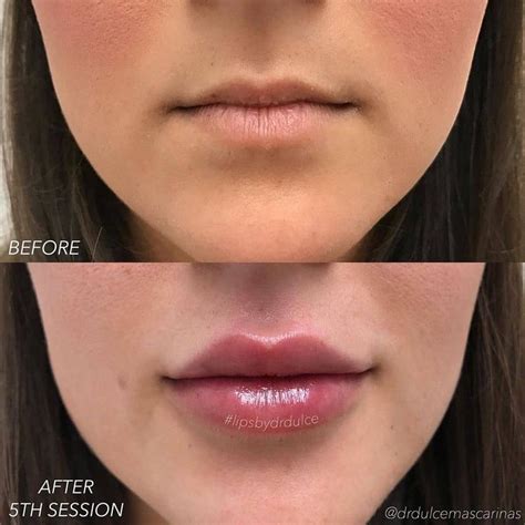 What Is The Best For Lip Fillers Jesusa Vo