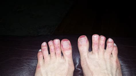 Bartonella Toes And Lyme Disease United By Lyme