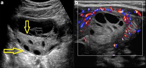Ovarian Torsion On Ultrasound