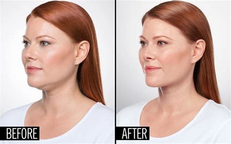 How A Dermatologist Can Eliminate Your Double Chin With An Injection