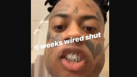 Rapper Boonk Gang Broken Jaw Wired Shut For Six Weeks Unable To Talk