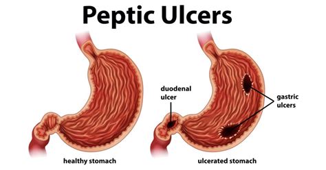 Acute Peptic Ulcer Definition Definition Fgd