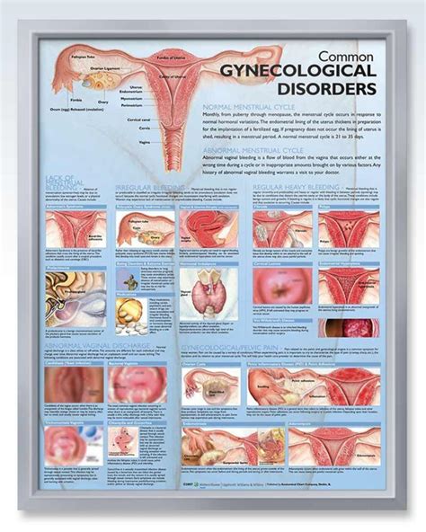 Gynecological Disorder Exam Room Anatomy Posters Clinicalposters