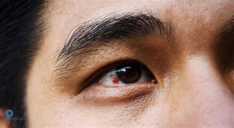 Pelebaran pembuluh darah ini biasanya cara berikutnya untuk mengatasi mata merah tanpa obat adalah selalu menjaga kebersihan mata anda. Bola Mata Putih Ada Bercak Merah - Joonka