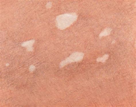 5 Causes Of White Spots Dots Or Patches On Legs