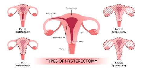 자궁 절제술 자궁의 외과 제거 의료 벡터 그림은 자군 절제술의 4 종류를 보여줍니다 부분 총 및 두 개의 급진적 인 유형 나팔관
