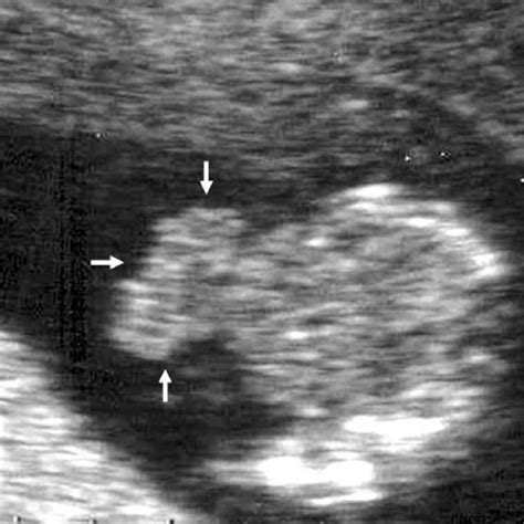 Transverse Sonogram At The Level Of The Chest Demonstrating Protrusion
