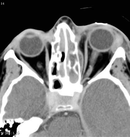 Subperiosteal Abscess Of The Orbit Radiology Reference Article