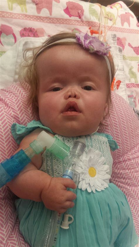 Jillian Is 8 Months Old And Has A Rare Form Of Dwarfism October Is Dwarfism Awareness Month