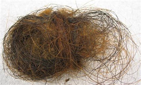 Huge Hairball Removed From Teenage Girls Stomach In Kyrgyzstan