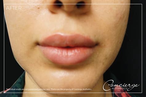 Before And After Photos Juvederm Volbella Lips Concierge Aesthetics
