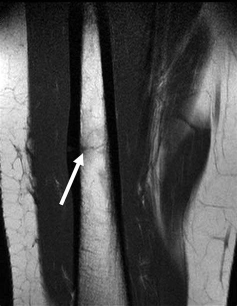Mri Features After Radiofrequency Ablation Of Osteoid Osteoma With