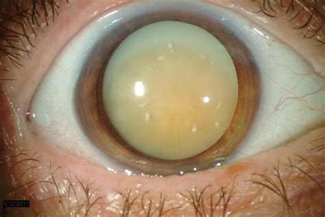 Morgagnian Cataract Ophthalmology The University Of Iowa