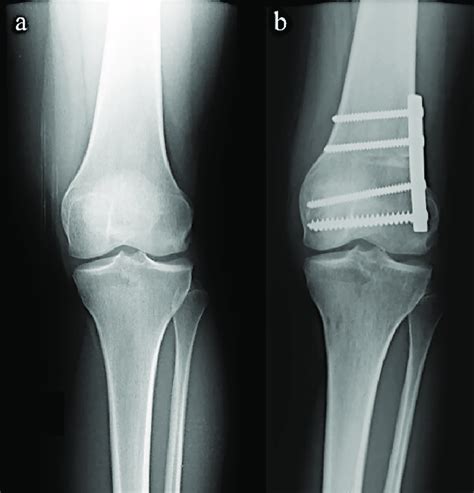 Preoperative And Postoperative Anteroposterior Ap Knee X Rays Fig