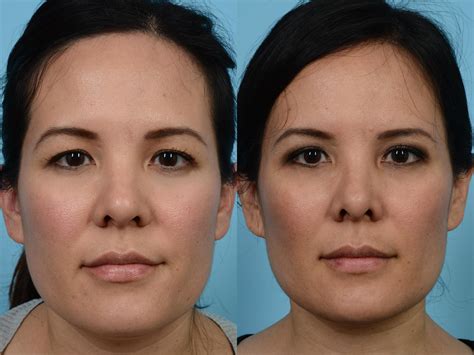 Botox before and after pictures reveal the reversal of fine lines & wrinkles such as crow's feet, brow lines, and forehead wrinkles. Brow Lift Before & After Photos Patient 488 | Chicago, IL ...