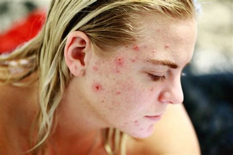 Whats The Difference Between Eczema And Cystic Acne And What Are The
