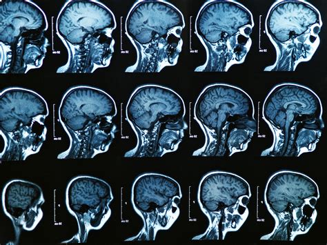 World First Massive Mri Study Charts Brain Changes From Birth To Death