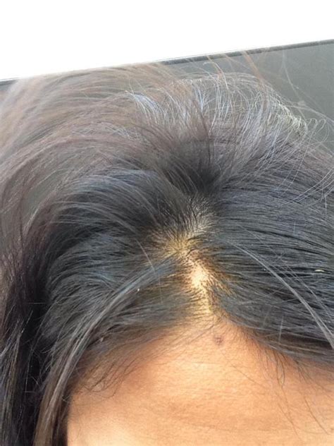 Cette perte de cheveux, notamment chez la femme , peut être expliquée et traitée de manière préventive ou curative. Est ce le début d'une pelade ? renseignez moi - Calvitie et perte de cheveux - FORUM Santé