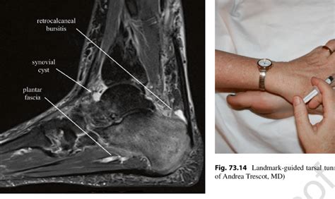 13 Stir Mri Sagittal Image Of The Ankle Showing Retrocalcaneal