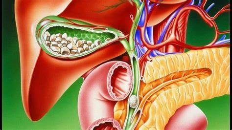 Желчекаменная болезнь - признаки, причины, симптомы, лечение и Картинка - Желчекаменная болезнь - признаки, причины, симптомы, лечение и