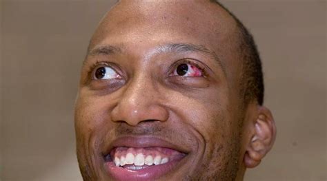American Basketball Player Ok After Eye Pops Out Of Socket