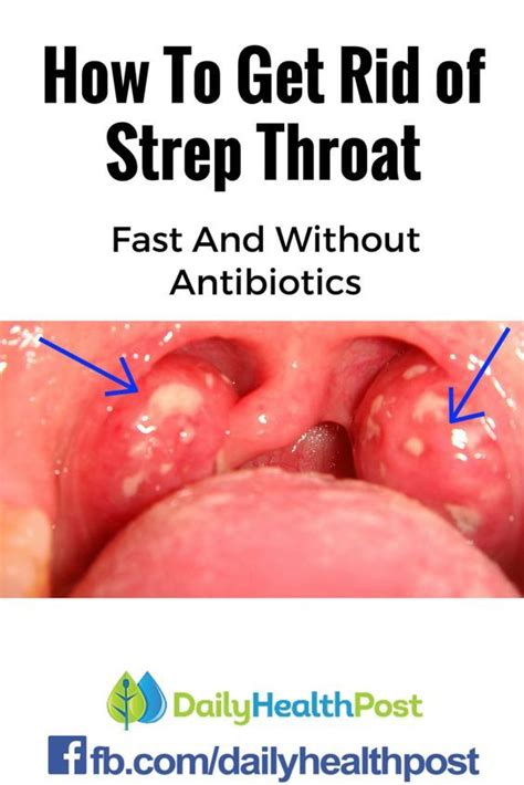 Ultimate Guide To Combat Warning Signs Of Strep Throat Strep Throat Holistic Health Natural