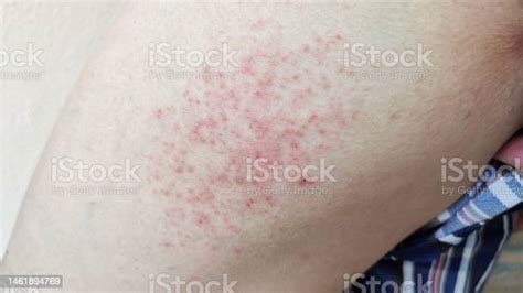 The Inflammation Skin And Rash Hives Itchy Skin On The Leg Stock Photo