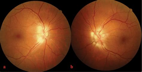 Colour Fundus Picture Of Right A And Left B Eyes Depicting