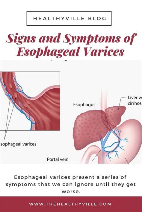 Esophageal Varices Causes Symptoms Grading Diagnosis Treatment The Best Porn Website