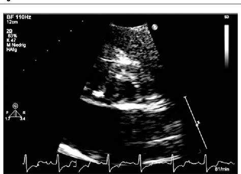 Figure 1 From Diagnosis Of Unicommissural Unicuspid Aortic Valve