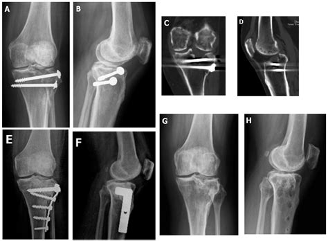 Jcm Free Full Text Arthroscopy Assisted Corrective Osteotomy