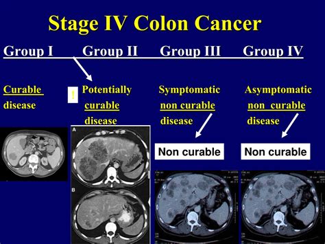 Ppt Colon Cancer Powerpoint Presentation Free Download Id9491216