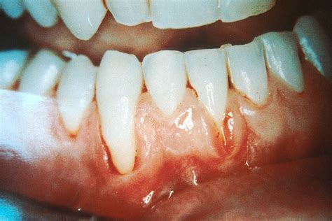 65 Of Rheumatoid Arthritis Patients Have Active Gum Disease • Eassist