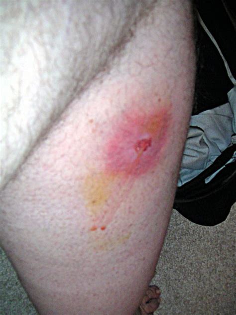 Spider Bite 1 This Is A Picture Of My Leg Two Days After T Flickr
