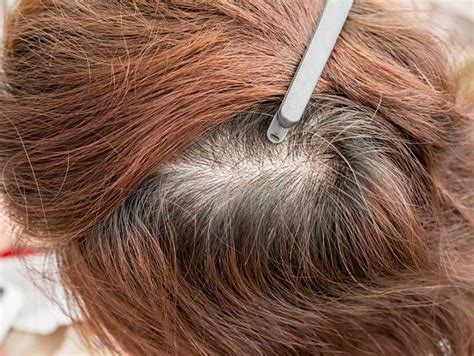 Thinning Hair Can Have Myriad Causes University Health News