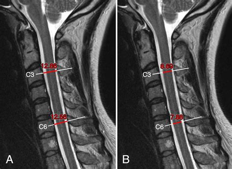 Normative MR Cervical Spinal Canal Dimensions Radiology