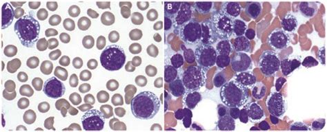 Mantle Cell Lymphoma With Unusual Burkitt Like Morphologic Features
