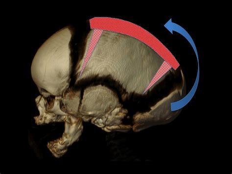 Minimally Invasive Endoscopic Sagittal Strip Craniectomy — Dallas