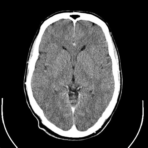 Filecomputed Tomography Of Human Brain 14png