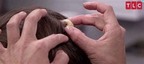 Dr Pimple Popper Treats Woman With Horn On Her Head
